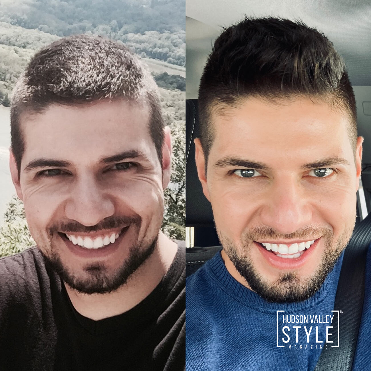 Before and after: 29 y/o vs. 34 y/o – How I overcame the stigma, fear, and judgment around Botox, or better know around men as Brotox, and other facial injectables – Men's Beauty with Dino Alexander